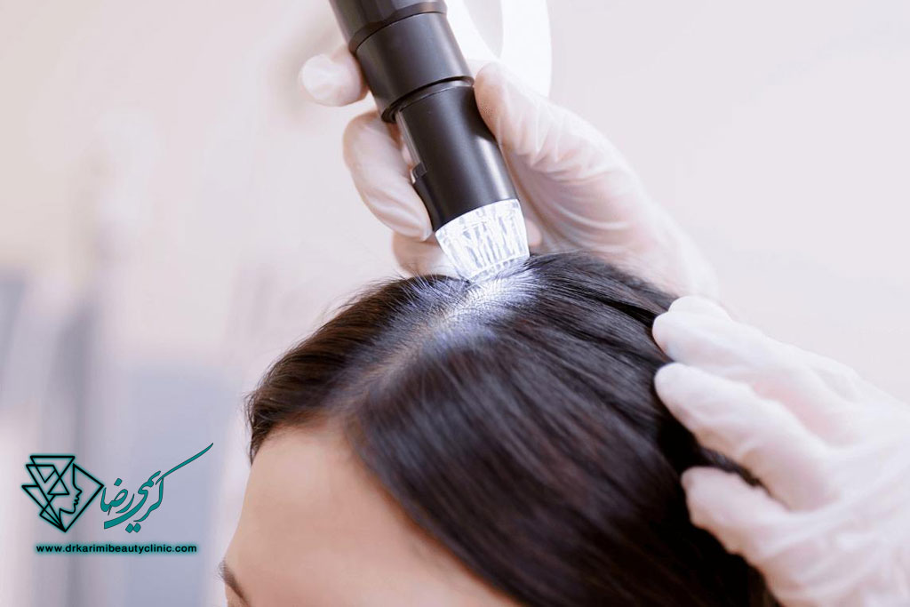 اسکالپ تراپی (درمان ریزش مو با میکرونیدلینگ سر) چگونه انجام می‌شود؟