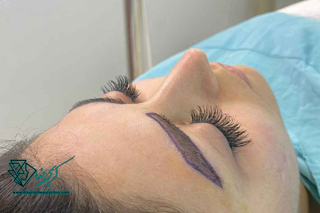 کاشت ابرو بدون جراحی