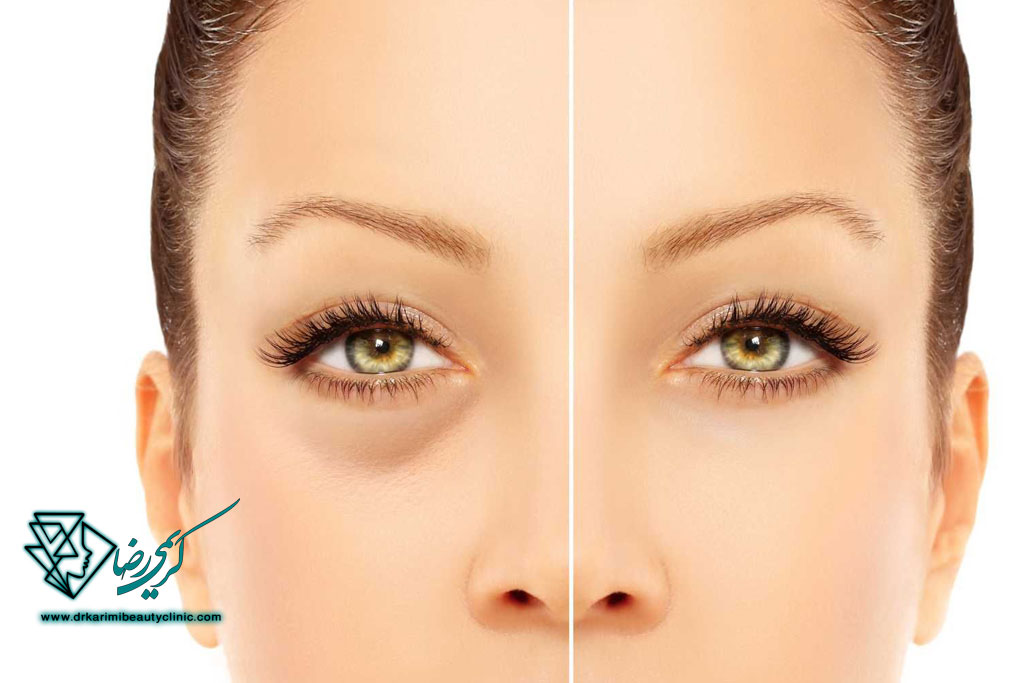روش‌های تخصصی برای بهبود تیرگی زیر چشم