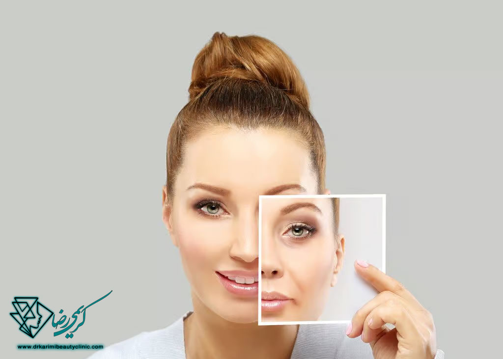 فیلر خط خنده